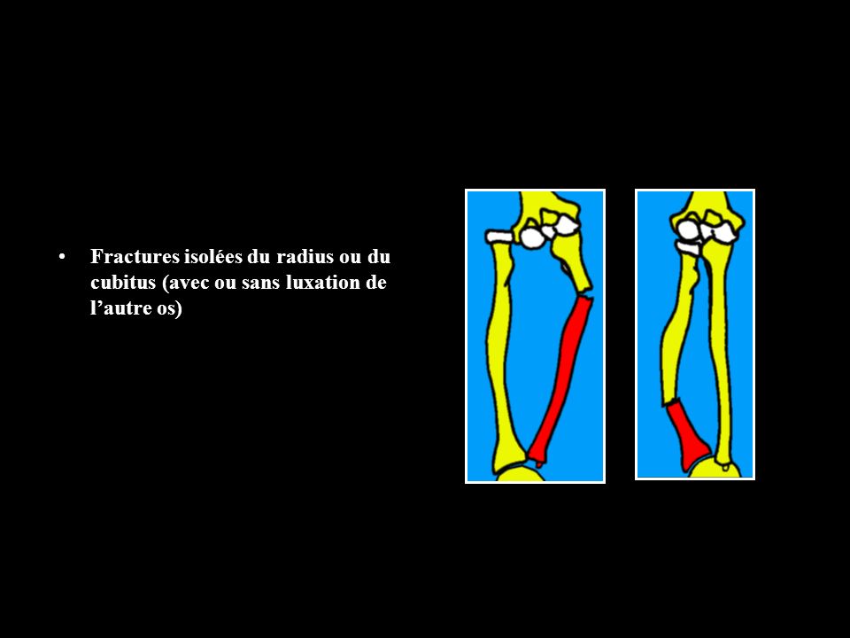 Fractures isolées du radius ou du cubitus (avec ou sans luxation de l’autre os)