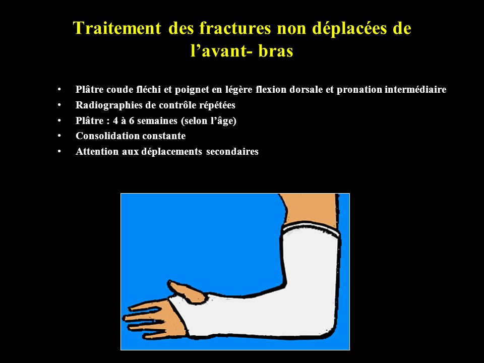 Traitement des fractures non déplacées de l’avant- bras
