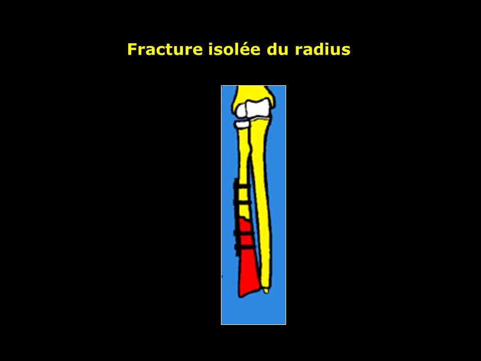 Fracture isolée du radius