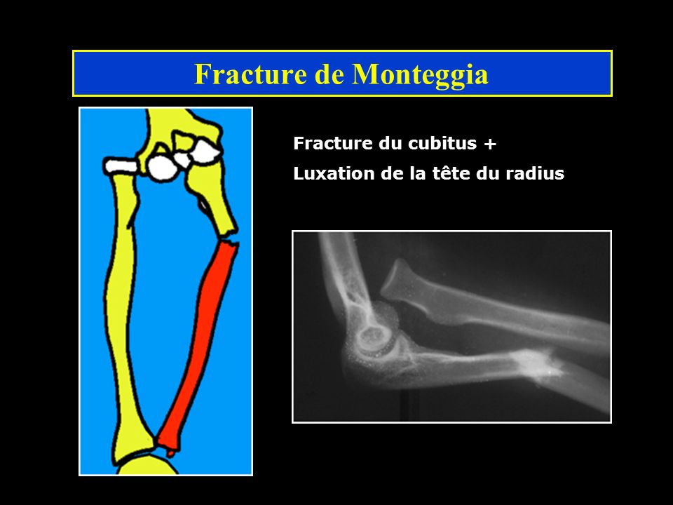 Fracture de Monteggia Fracture du cubitus +