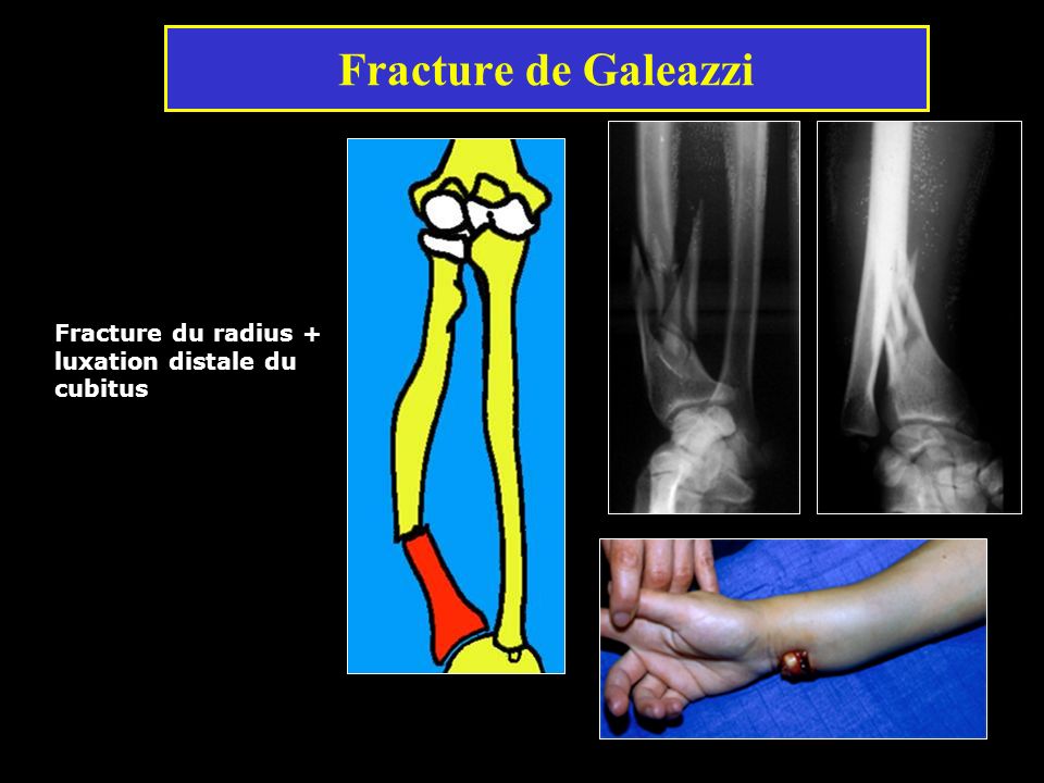 Fracture de Galeazzi Fracture du radius + luxation distale du cubitus