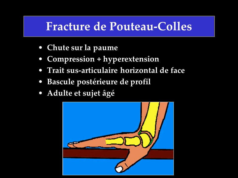 Fracture de Pouteau-Colles