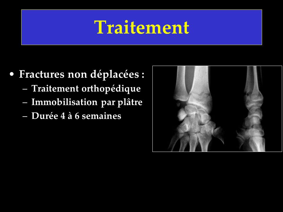 Traitement Fractures non déplacées : Traitement orthopédique