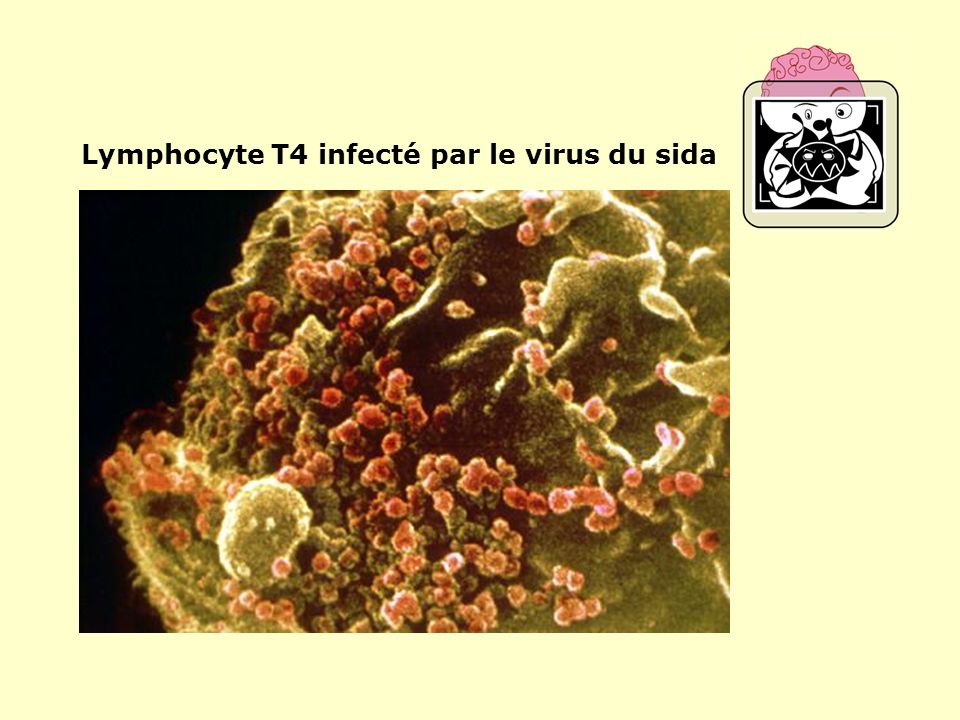 Lymphocyte T4 infecté par le virus du sida