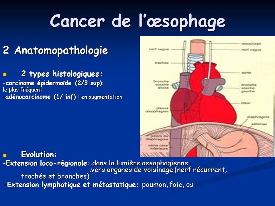 Cancer de l’œsophage 2 Anatomopathologie 2 types histologiques :