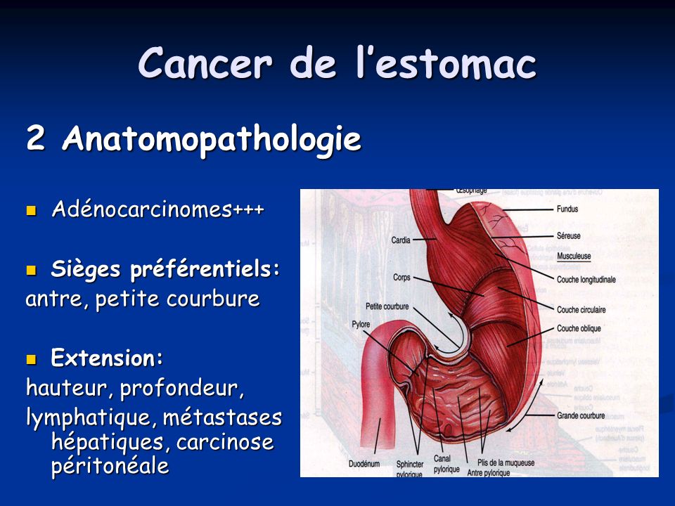 Cancer de l’estomac 2 Anatomopathologie Adénocarcinomes+++
