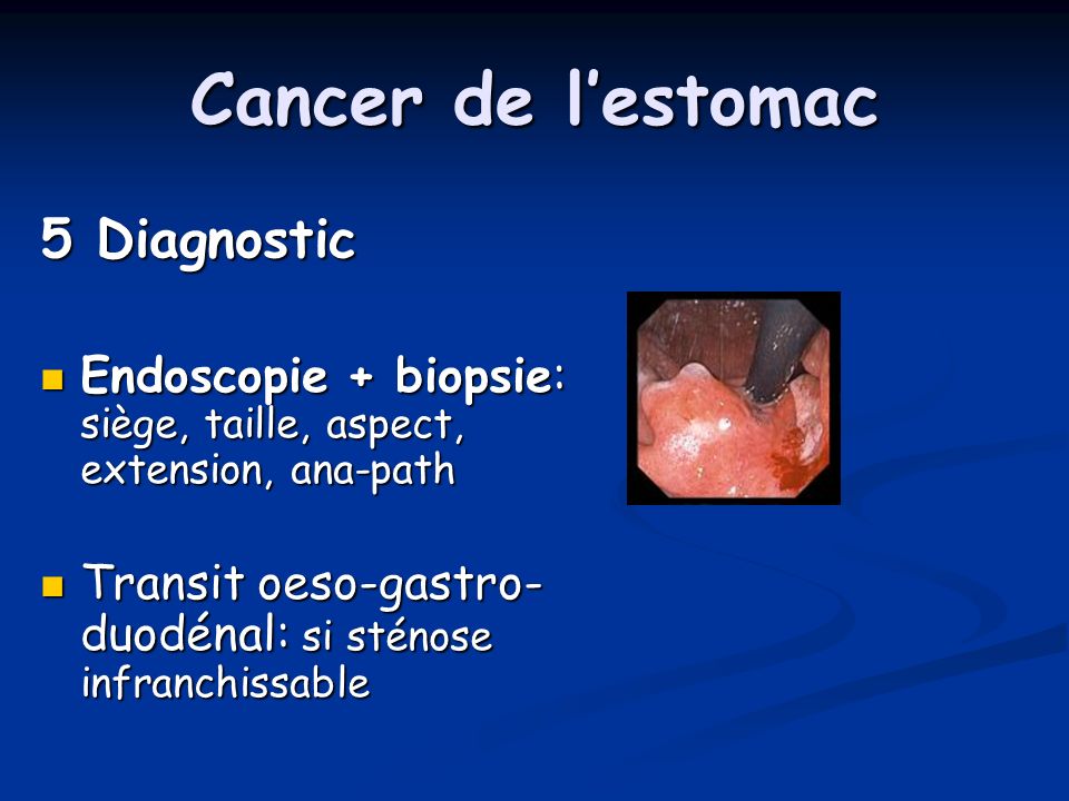 Cancer de l’estomac 5 Diagnostic