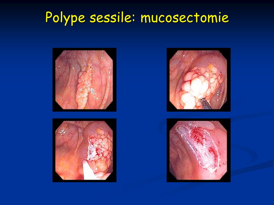 Polype sessile: mucosectomie