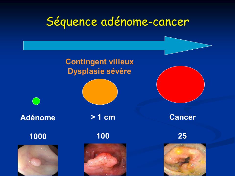 Séquence adénome-cancer