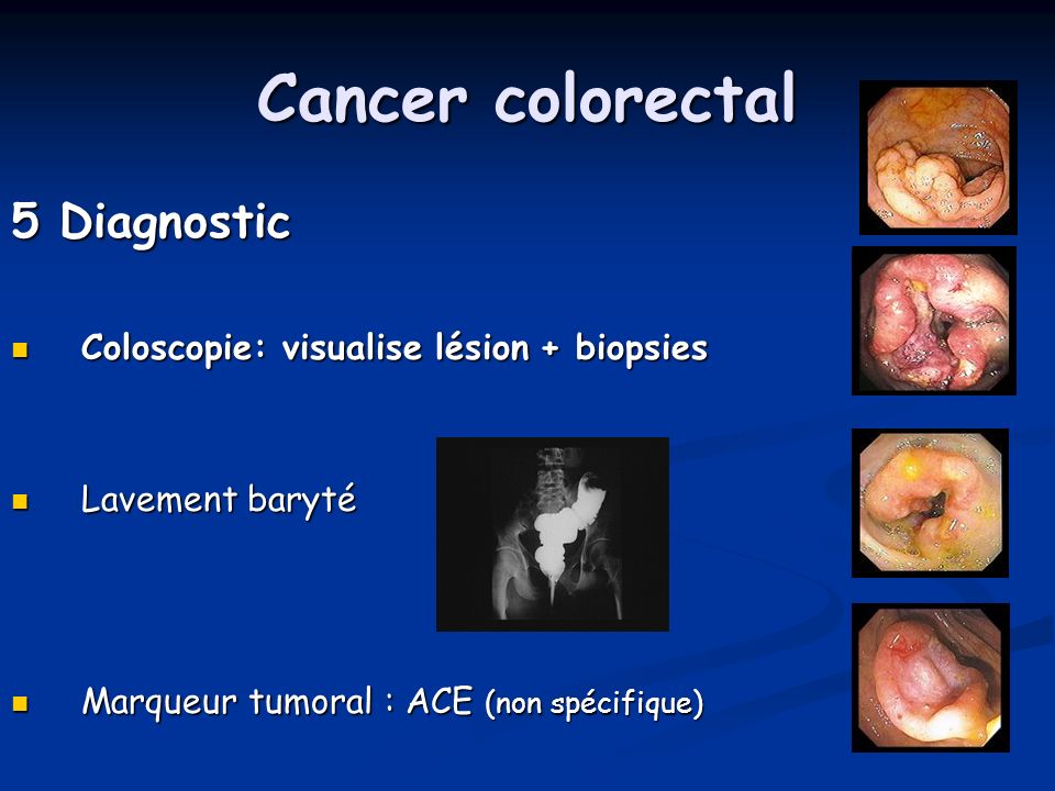 Cancer colorectal 5 Diagnostic Coloscopie: visualise lésion + biopsies