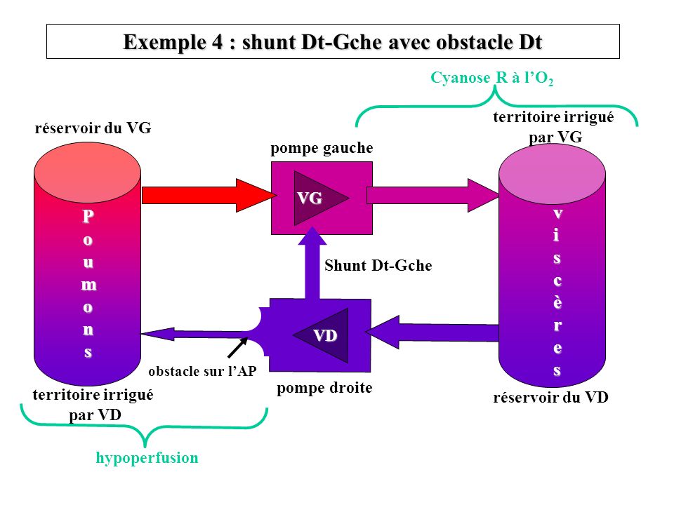 Exemple 4 : shunt Dt-Gche avec obstacle Dt