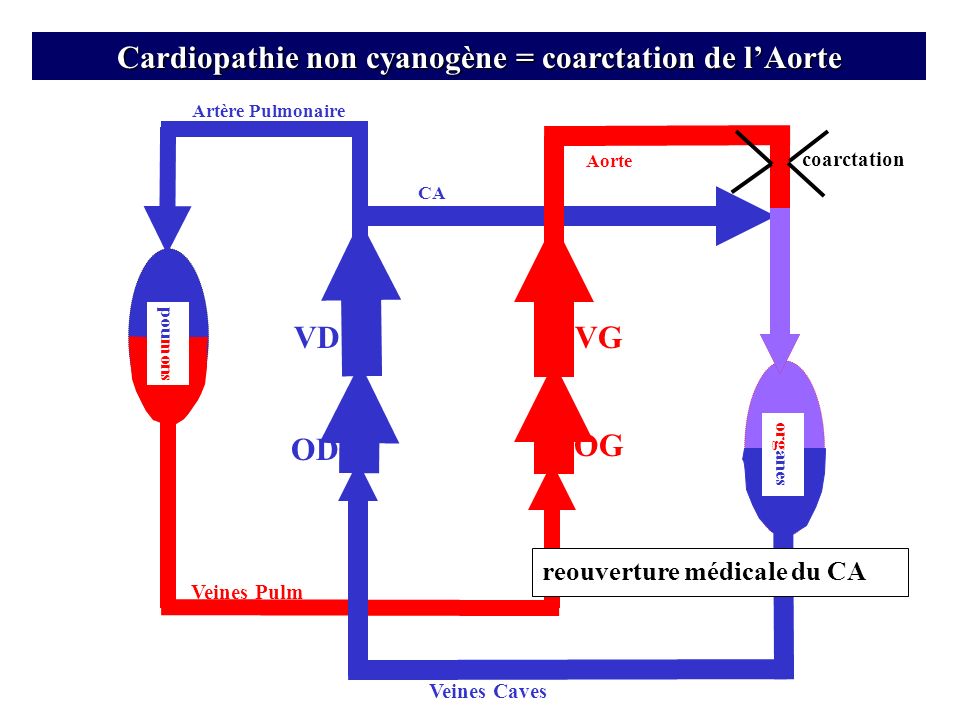 Cardiopathie non cyanogène = coarctation de l’Aorte