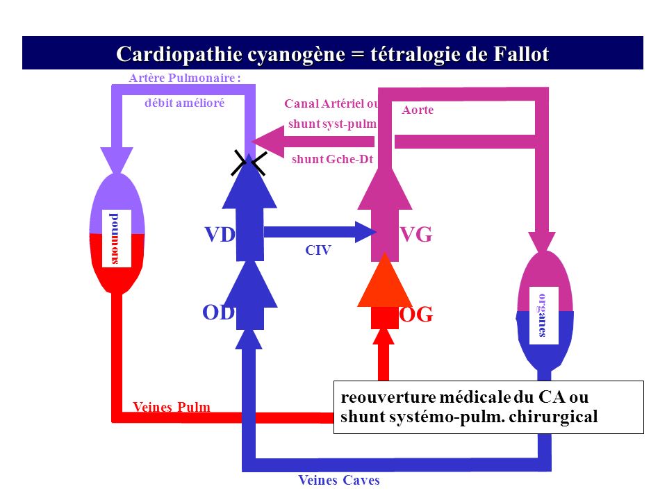 Cardiopathie cyanogène = tétralogie de Fallot