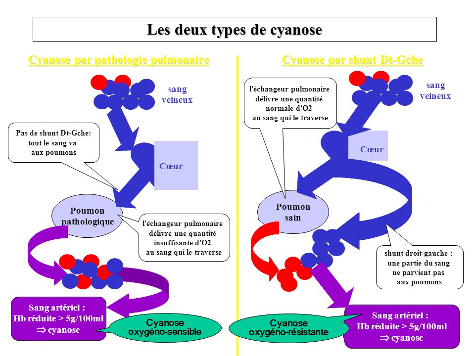 Les deux types de cyanose