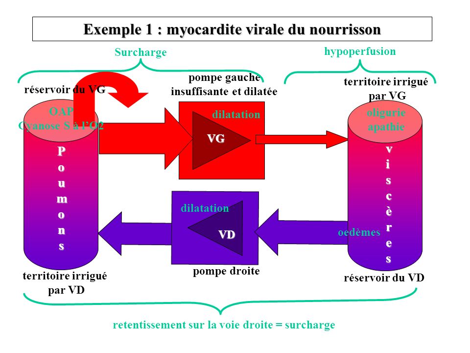 Exemple 1 : myocardite virale du nourrisson