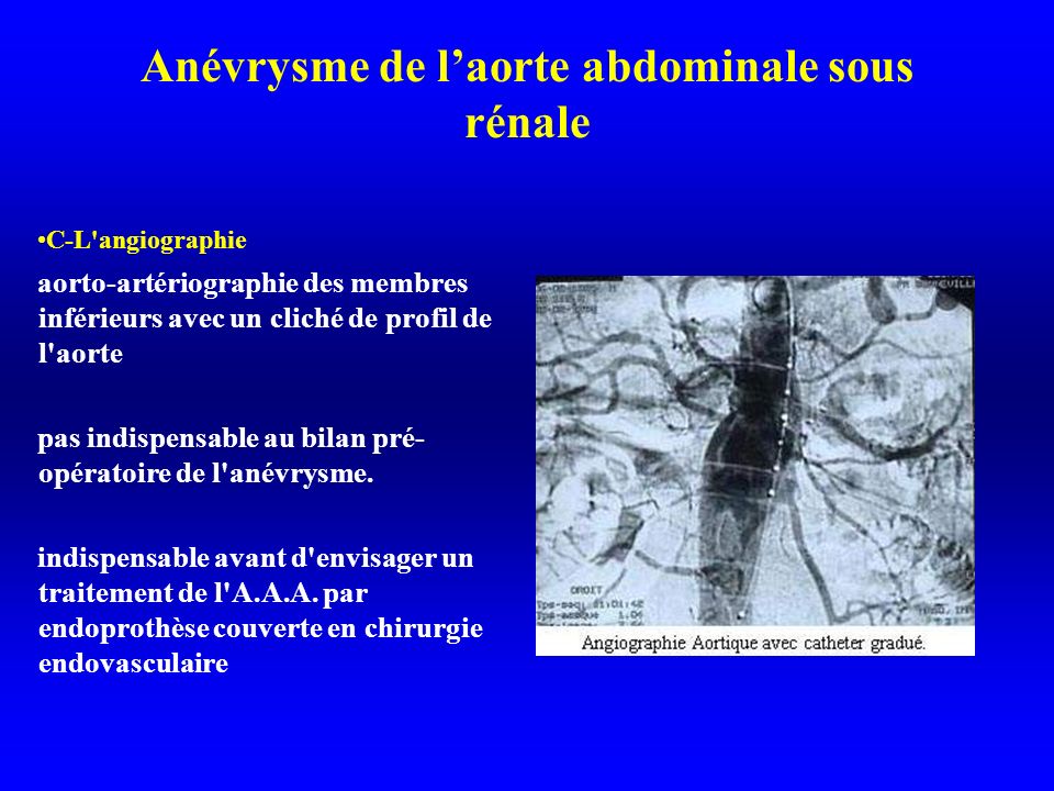 Anévrysme de l’aorte abdominale sous rénale