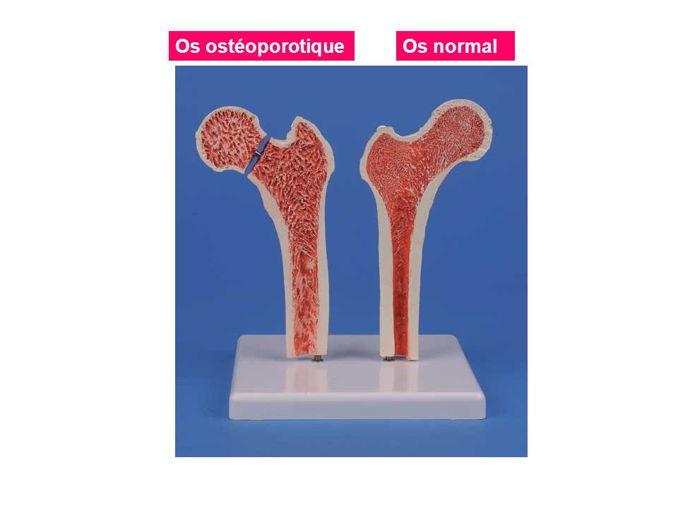 Os ostéoporotique Os normal