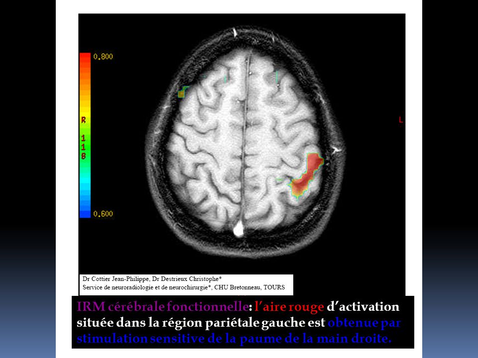 IRM cérébrale fonctionnelle: l’aire rouge d’activation située dans la région pariétale gauche est obtenue par stimulation sensitive de la paume de la main droite.