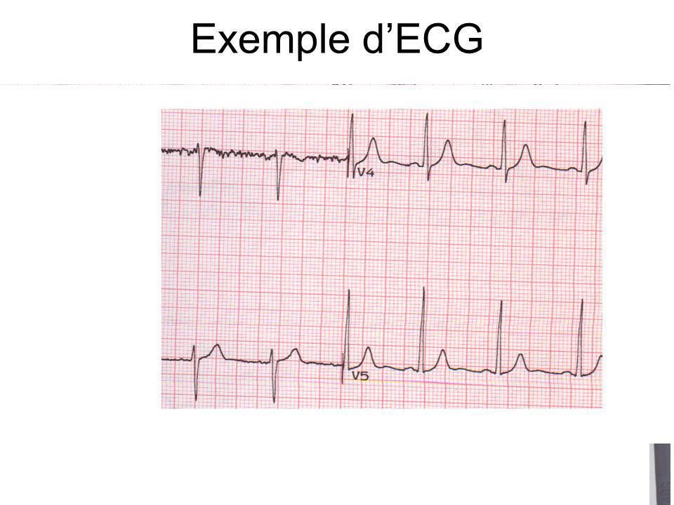 Exemple d’ECG