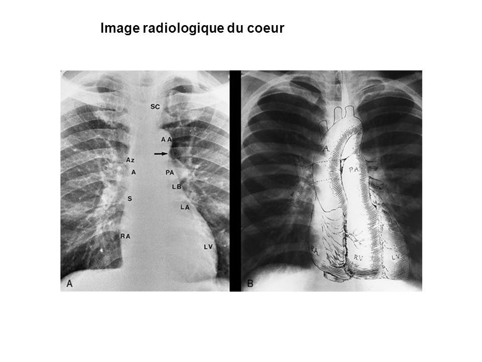 Image radiologique du coeur