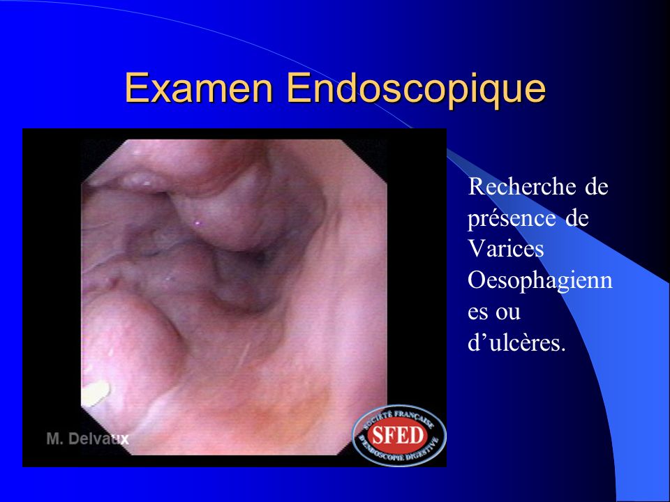 Examen Endoscopique Recherche de présence de Varices Oesophagiennes ou d’ulcères.