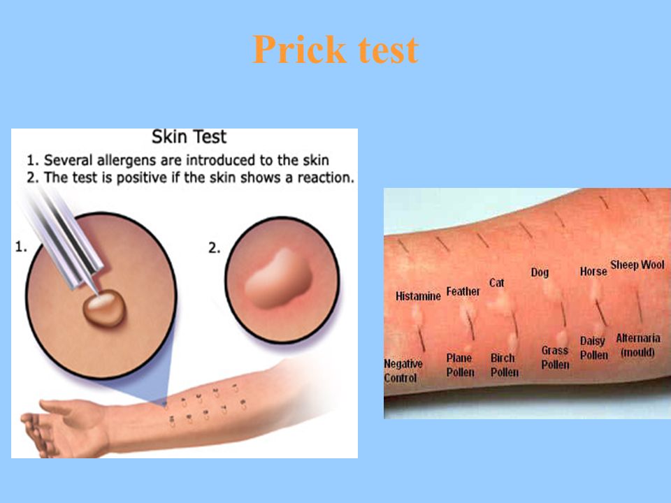 Кожные Пробы На Аллергены Цена