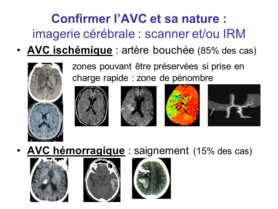 Confirmer l’AVC et sa nature : imagerie cérébrale : scanner et/ou IRM
