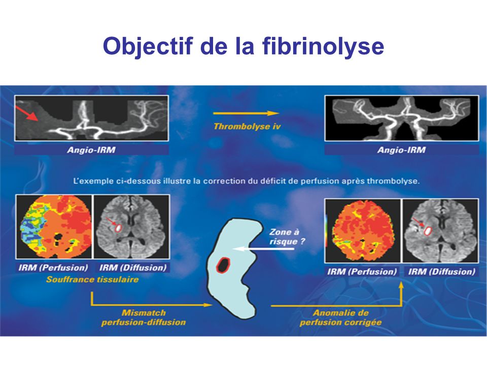 Objectif de la fibrinolyse