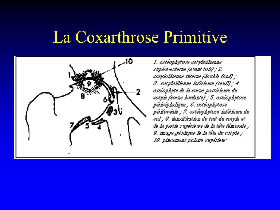 La Coxarthrose Primitive