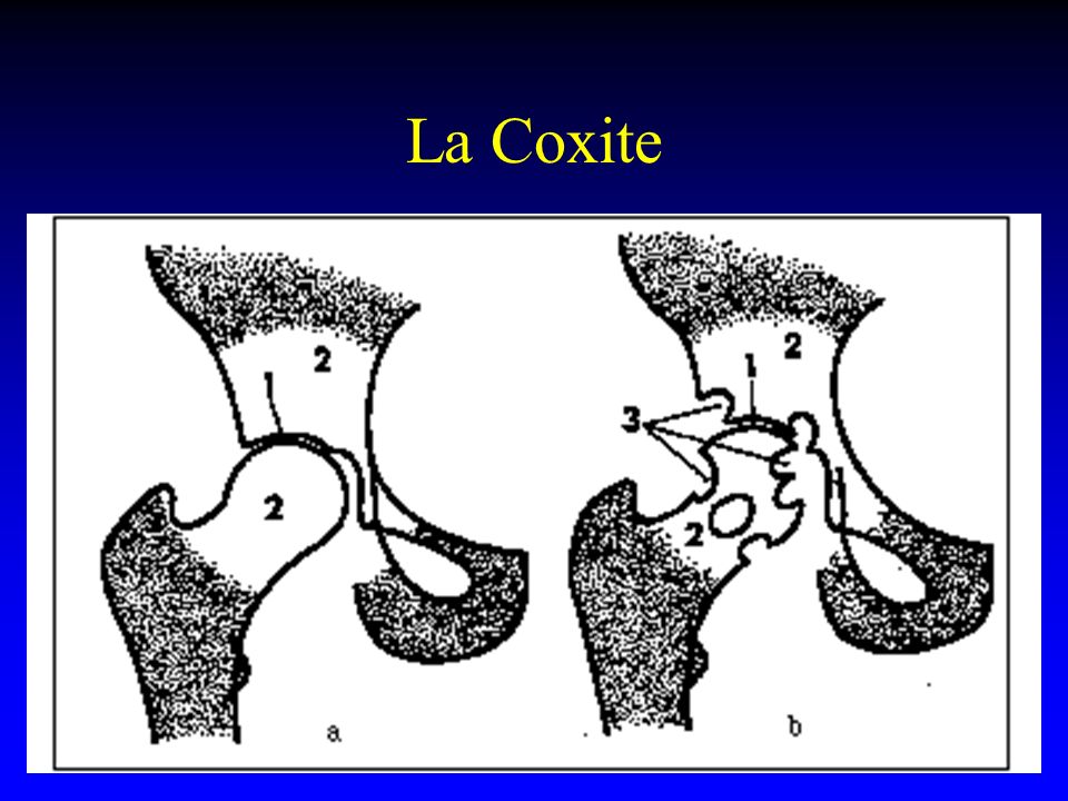 La Coxite