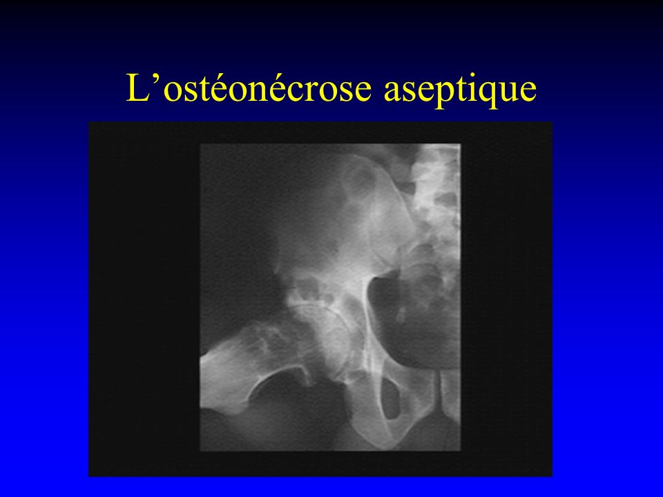 L’ostéonécrose aseptique