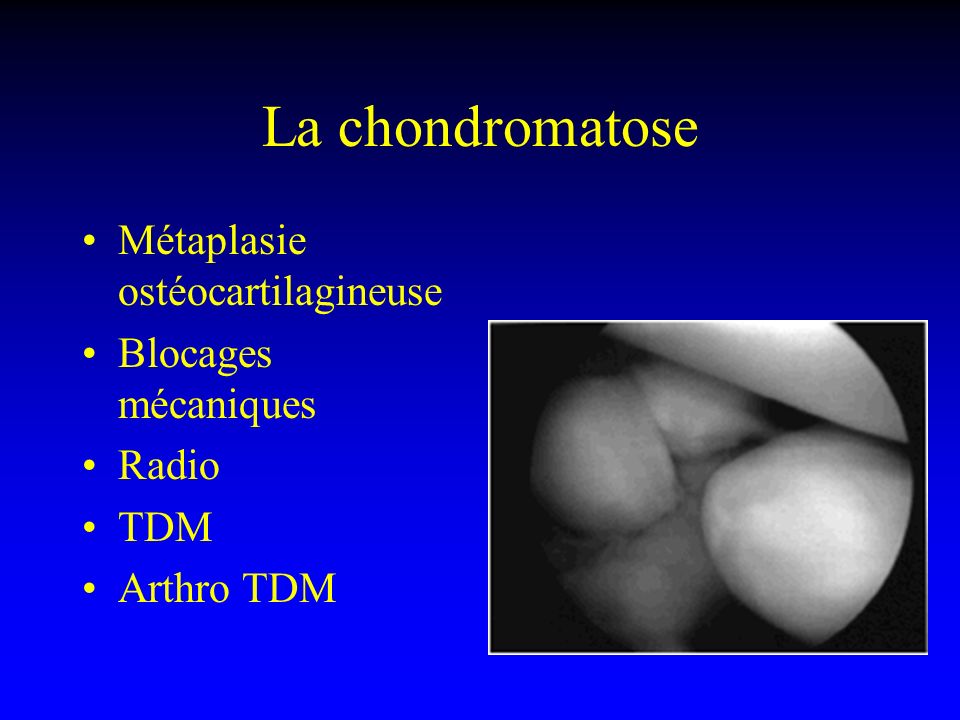 La chondromatose Métaplasie ostéocartilagineuse Blocages mécaniques