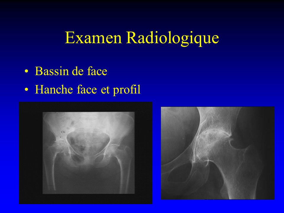 Examen Radiologique Bassin de face Hanche face et profil