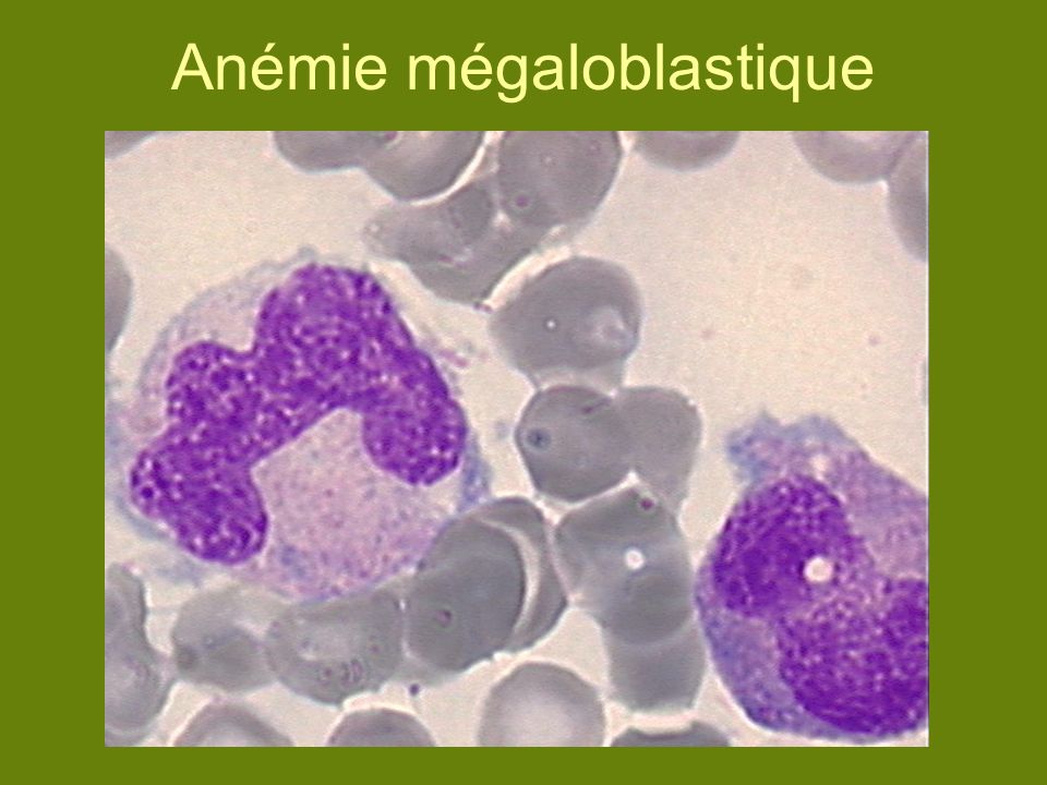l anemie megaloblastique