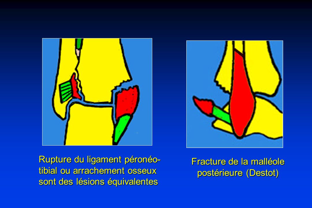 Fracture de la malléole postérieure (Destot)