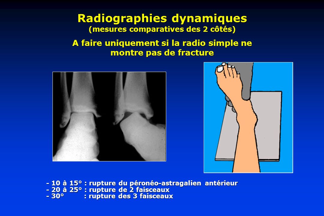 Radiographies dynamiques (mesures comparatives des 2 côtés)