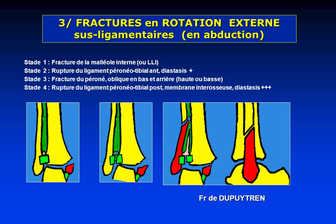 3/ FRACTURES en ROTATION EXTERNE sus-ligamentaires (en abduction)
