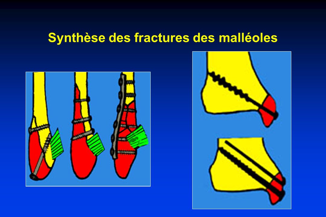 Synthèse des fractures des malléoles