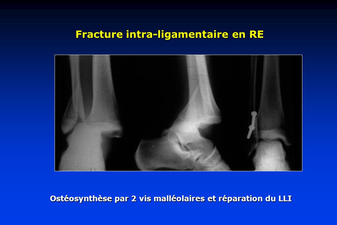 Fracture intra-ligamentaire en RE