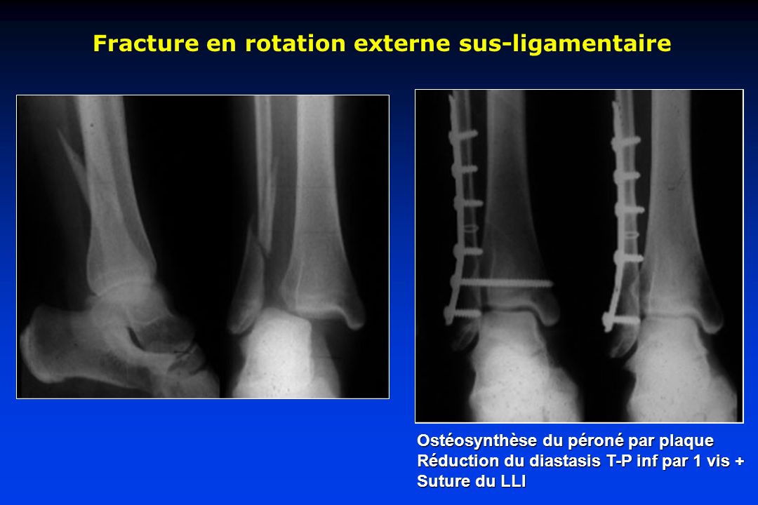 Fracture en rotation externe sus-ligamentaire