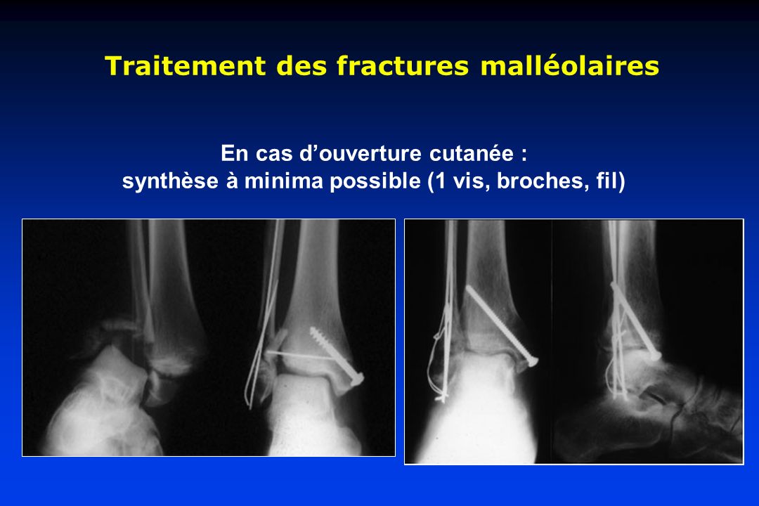 Traitement des fractures malléolaires