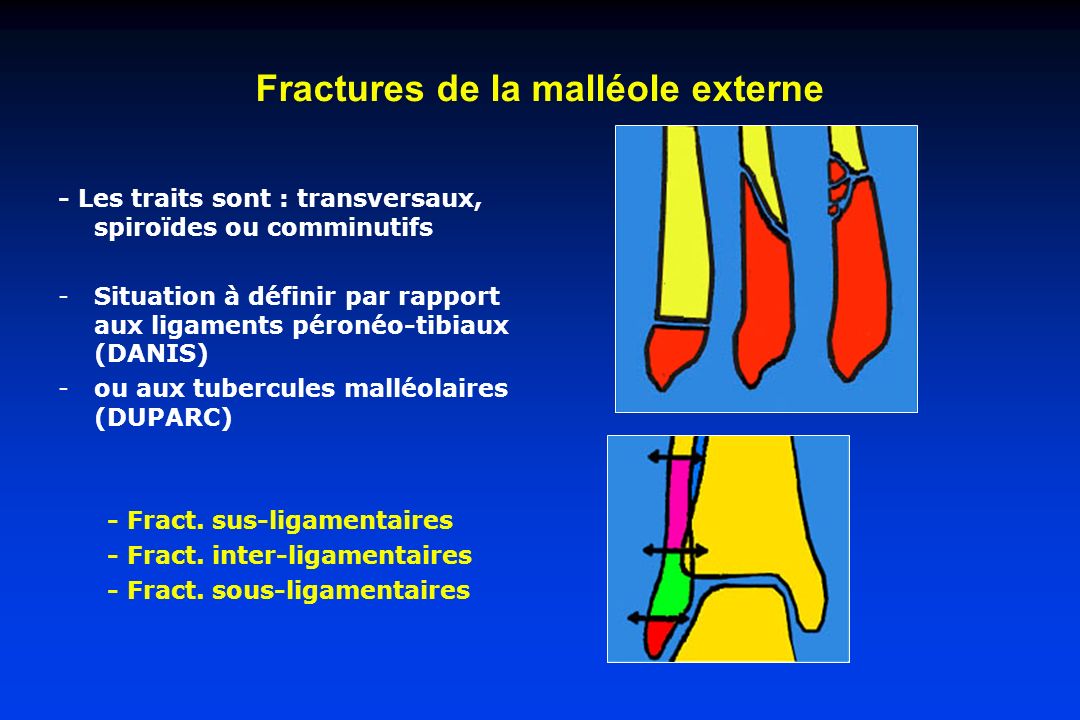 Fractures de la malléole externe