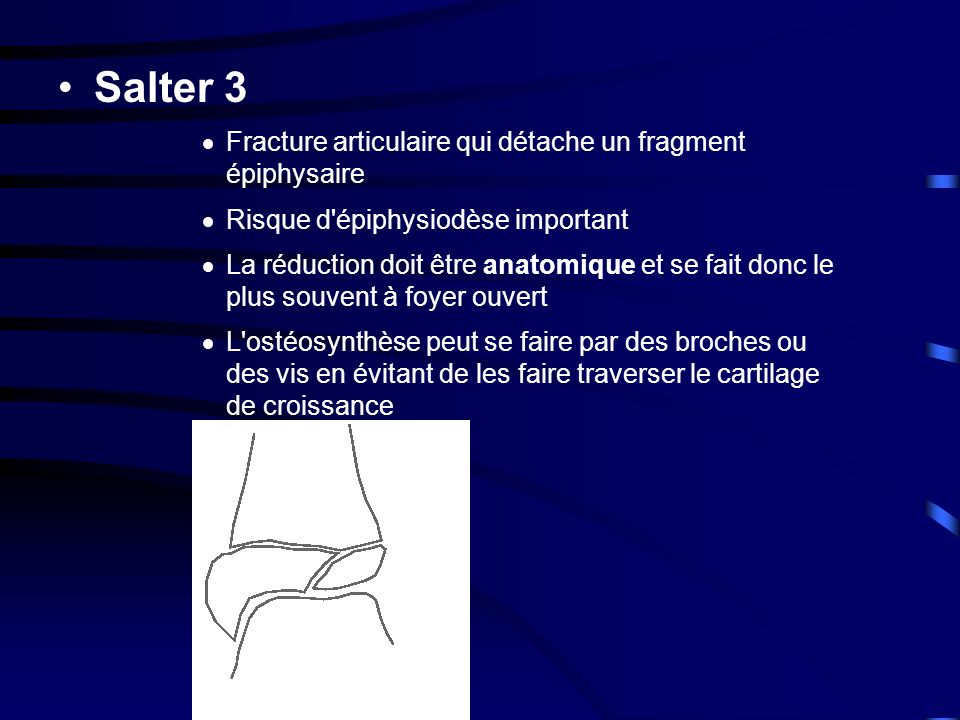 Salter 3 Fracture articulaire qui détache un fragment épiphysaire