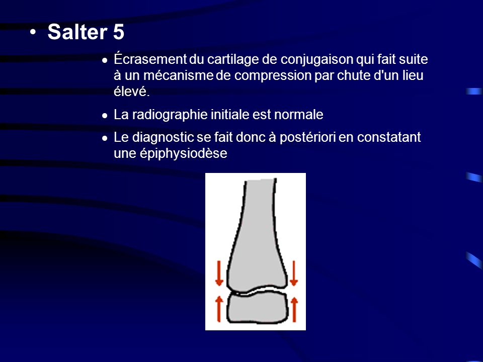Salter 5 Écrasement du cartilage de conjugaison qui fait suite à un mécanisme de compression par chute d un lieu élevé.