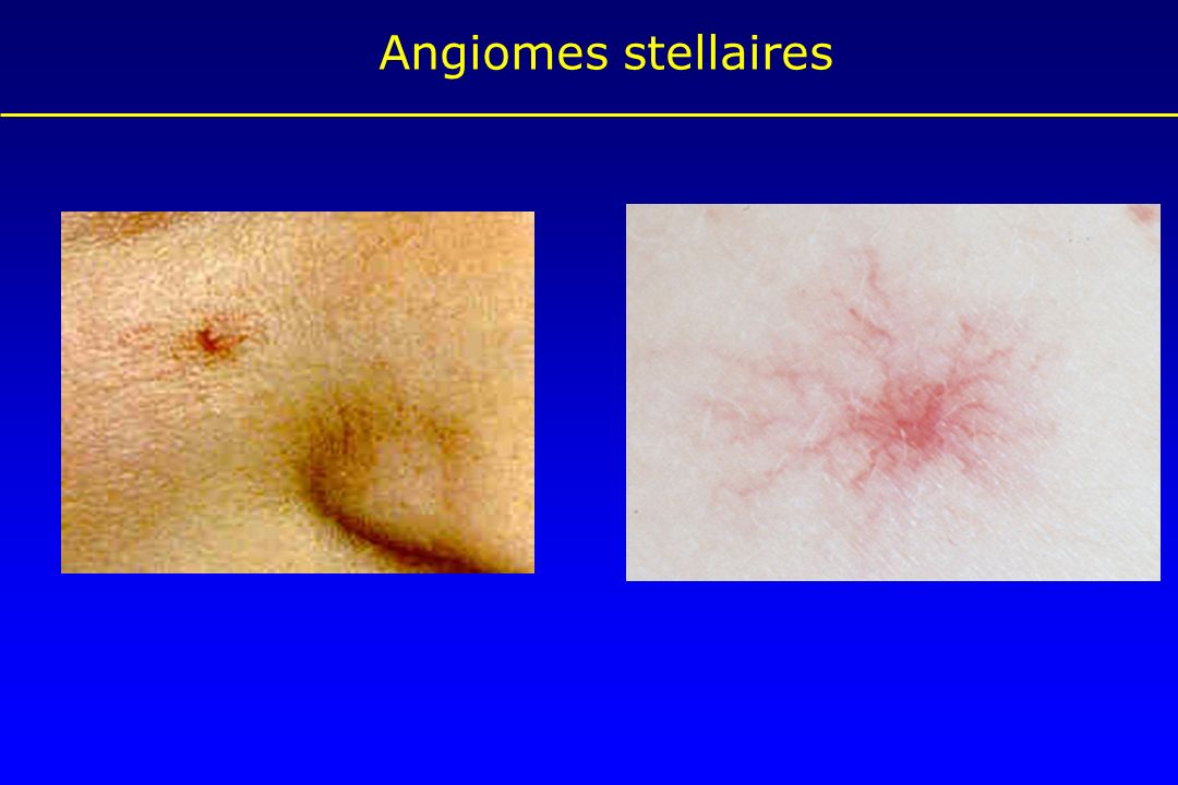 Angiomes stellaires