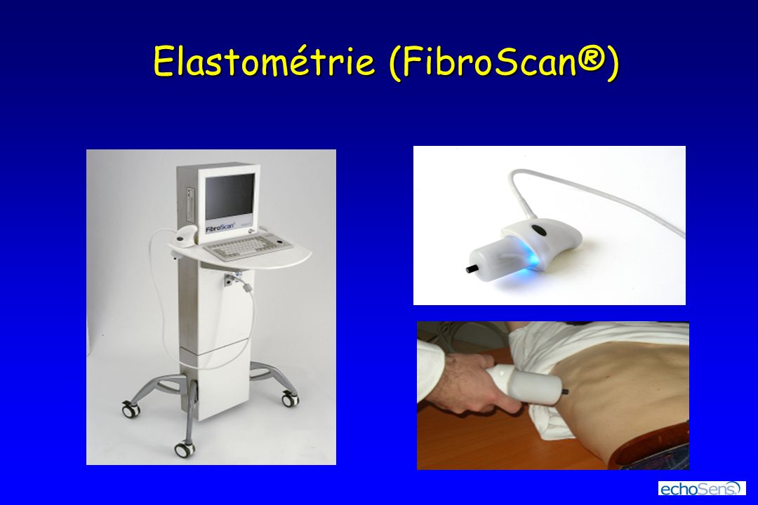Elastométrie (FibroScan®)