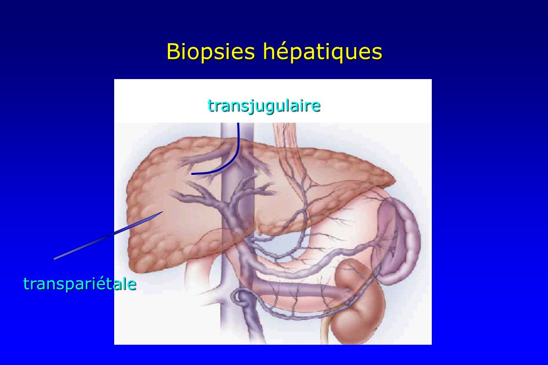 Biopsies hépatiques transjugulaire transpariétale