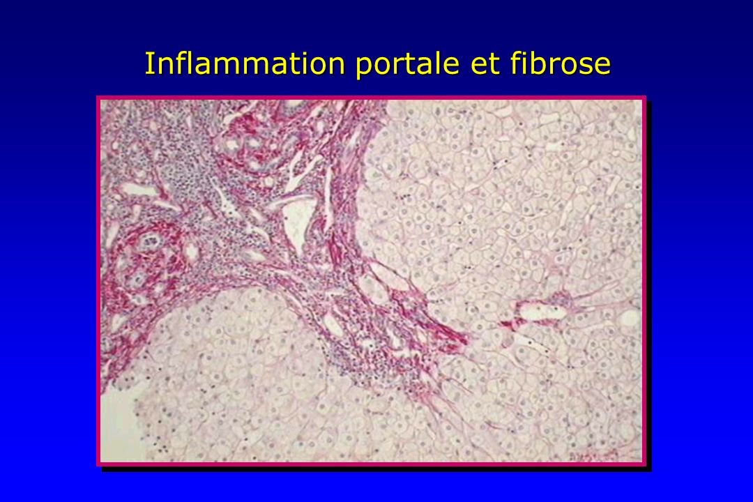 Inflammation portale et fibrose