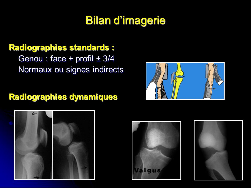 Bilan d’imagerie Radiographies standards : Genou : face + profil ± 3/4