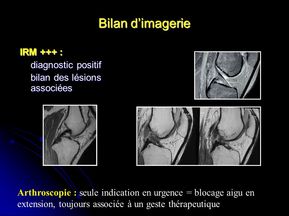 Bilan d’imagerie IRM +++ : diagnostic positif